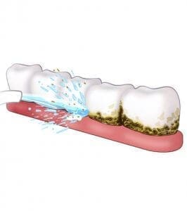Mandelstein-Entferner Wasserflosser-Wasserspülung-Säubert-Zahnfleisch-Zähne-Zahnspange