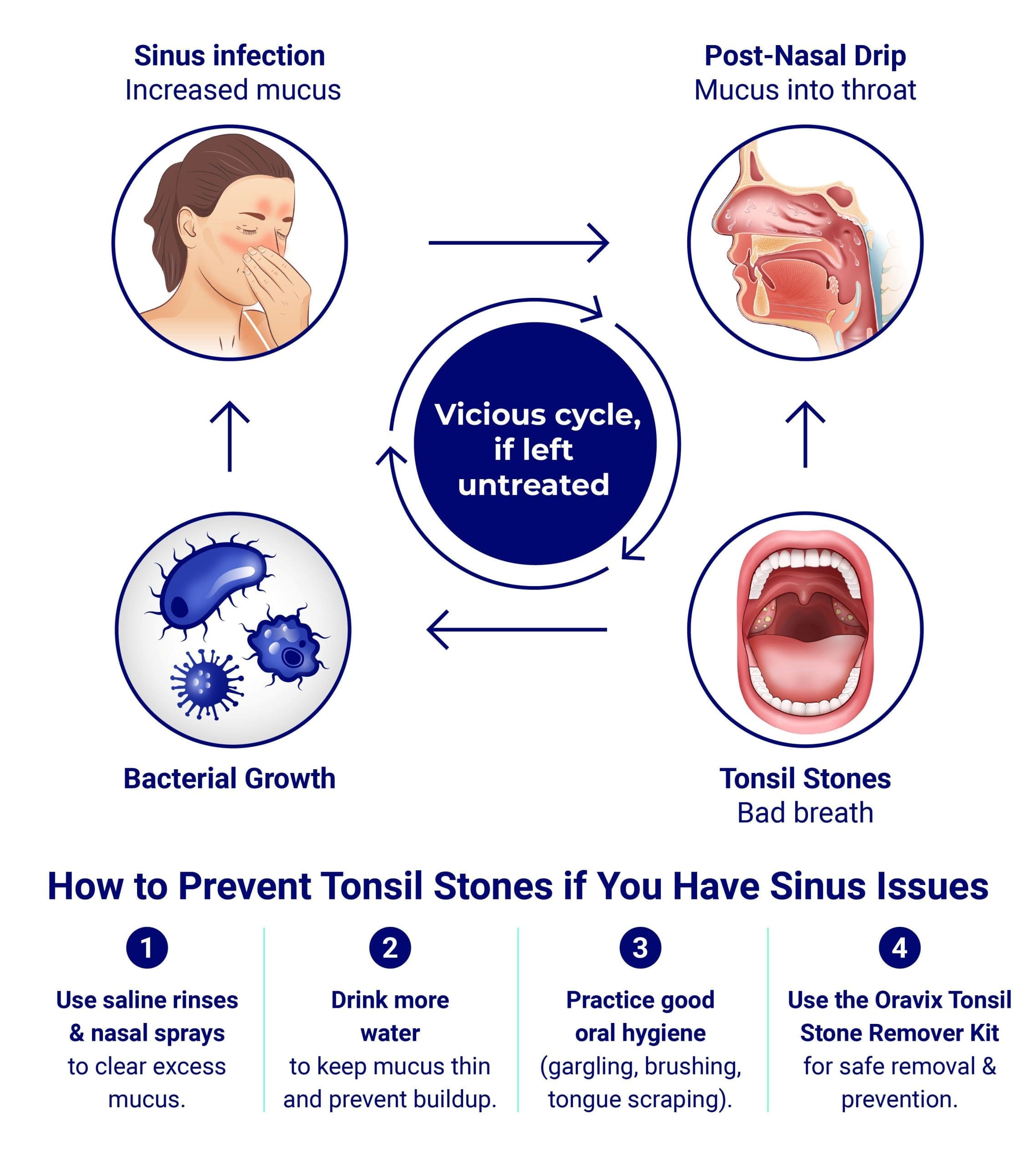 Step by Step post nasal drip to tonsil stones process Infographic showing how sinus issues can lead to tonsil stones. The cycle begins with a sinus infection that causes mucus to drip down the throat (post-nasal drip). This mucus carries bacteria, which then gets trapped in the tonsils, hardens, and forms tonsil stones. The center of the image says: "Yes, sinus issues can cause tonsil stones."<br />
At the bottom, four prevention tips are listed:</p>
<p>Use saline rinses to keep sinuses clear.</p>
<p>Stay hydrated to thin mucus.</p>
<p>Rinse your tonsils 2–3 times a week to flush out debris.</p>
<p>Use a tongue scraper daily to stop bacteria buildup.