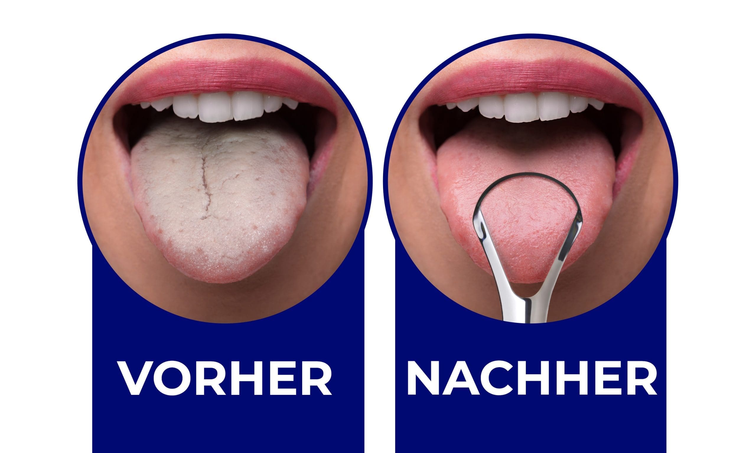 Before-After-DE Vor und nach der Verwendung eines Zungenschabers