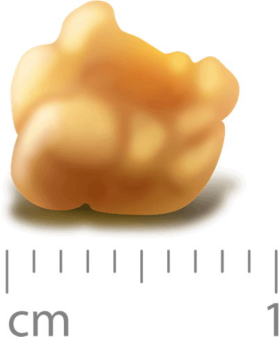 Tonsil stones are often less than 1cm in size. Illustration of a tonsil stone and a ruler. 