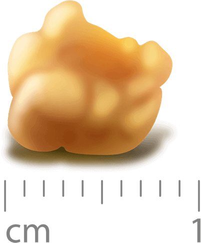 Size-Tonsil-Stones tonsil stone with a ruler