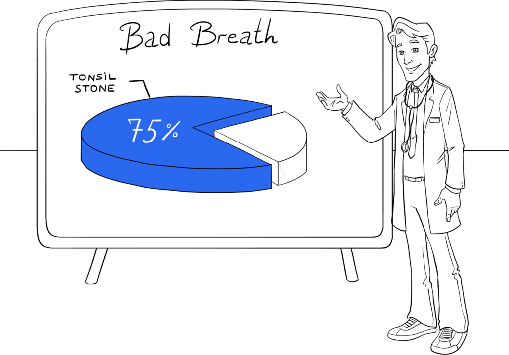 Graph showing that 75% of people with bad breath had tonsil stones. 