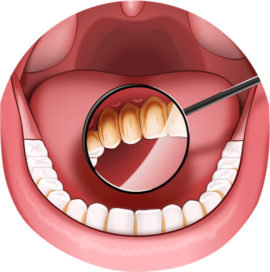 Tonsil stones are more common in people with poor oral hygiene. Illustration showing an open mouth and teeth with plaque buildup.  