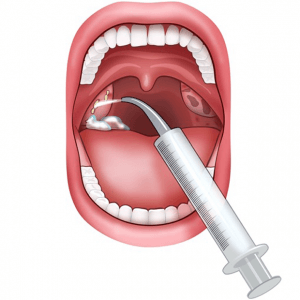 Kit de nettoyage d'amygdales Oral Icon® - Enlevez les caséums en 1 minute -  Comprend 1 pipette d'aspiration - 1 seringue gorge/amygdales - Qualité  médicale - Sans BPA ni verre - Haleine fraîche ultime : : Hygiène  et Santé