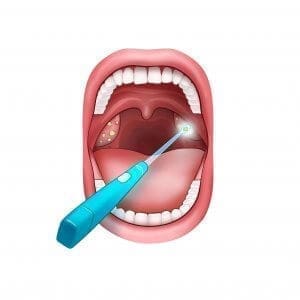 tonsil scoop