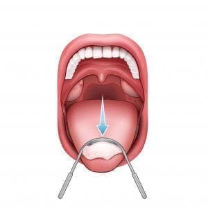 Kit de nettoyage d'amygdales Oral Icon® - Enlevez les caséums en 1 minute -  Comprend 1 pipette d'aspiration - 1 seringue gorge/amygdales - Qualité  médicale - Sans BPA ni verre - Haleine