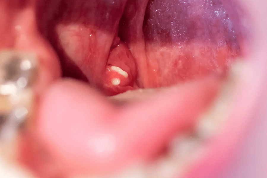 tonsil-stone-real-picture Close-up photo of the inside of a person's mouth showing a visible white tonsil stone lodged in a tonsil crypt near the back of the throat. Surrounding tissue appears slightly red.