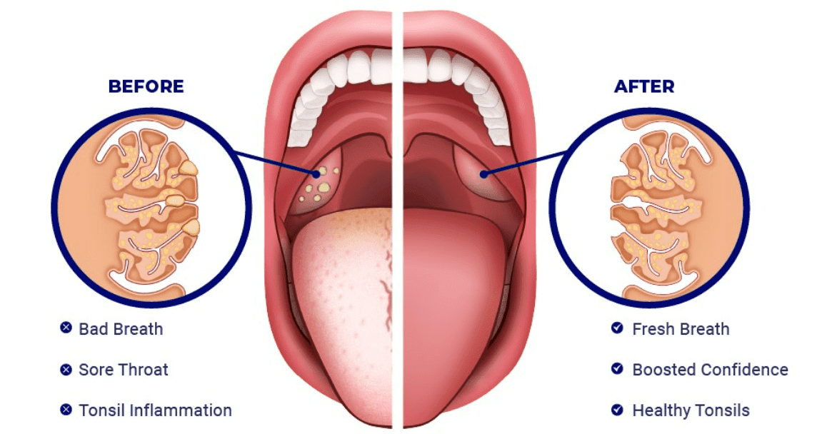 tonsil stone remover kit_tackling bad breath a-before-and-after-anatomical-comparison-between-tonsil-stones-tonsil-and-a-clear-tonsil