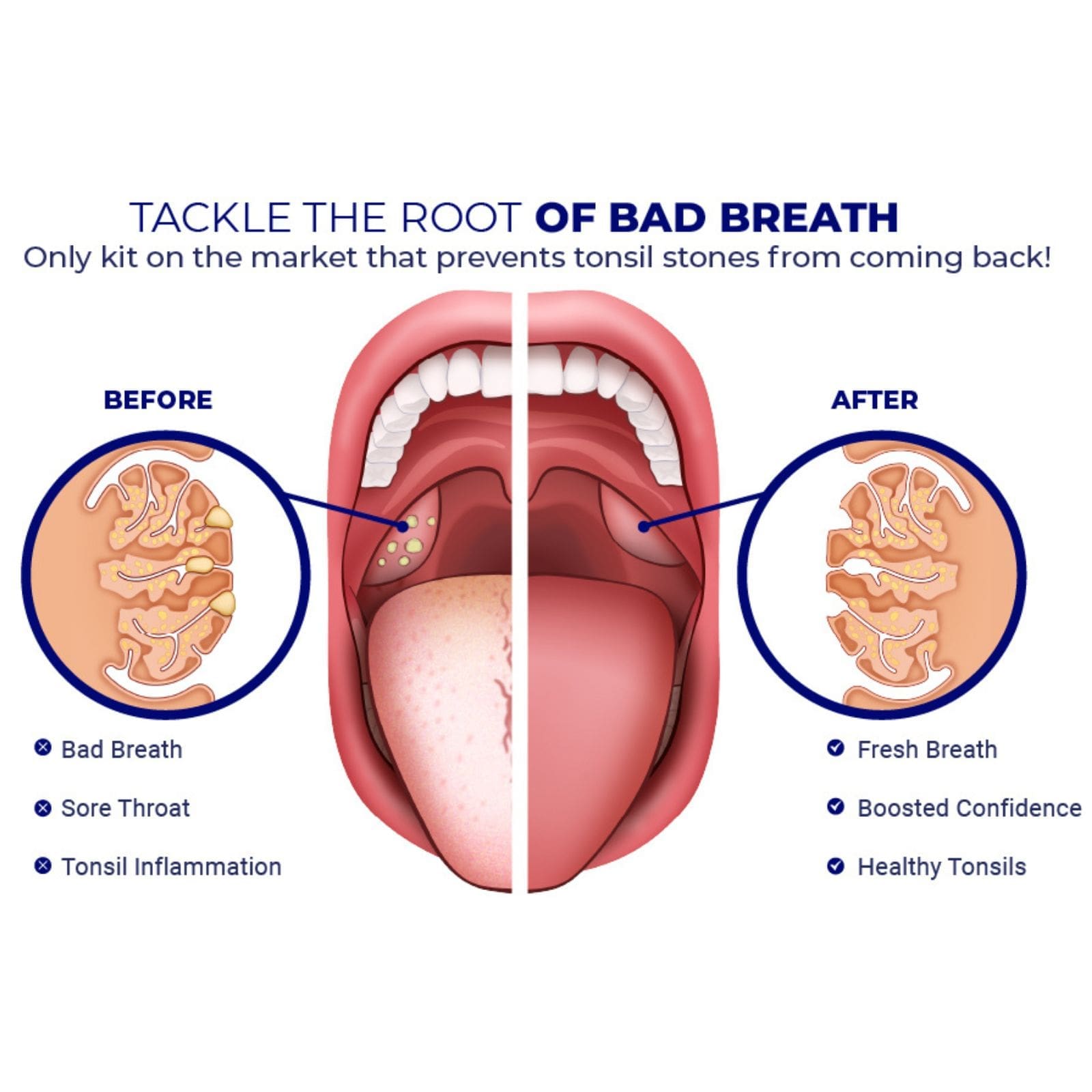 How to Remove Tonsil Stones at Home With Cotton Swab: Easy & Safe Steps